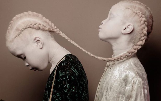 Zwilllingsschwestern mit Albinismus erobern Modewelt.