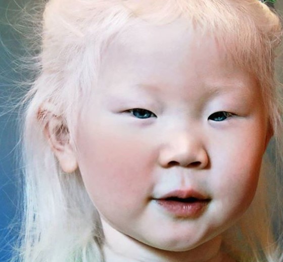 15 Albinos aus allen Teilen der Erde.