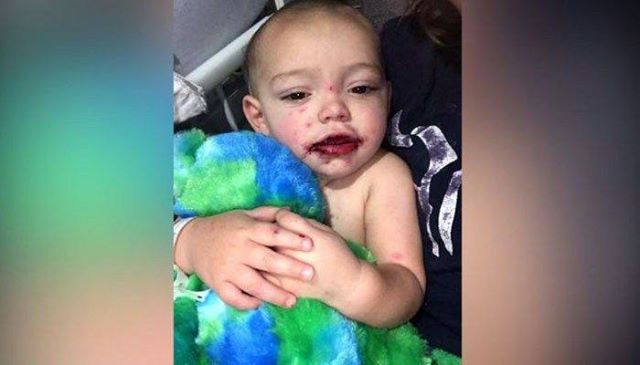 Mama entdeckt blutige Blasen im Mund ihres 1-jährigen – die Diagnose des Arztes lässt sie am Boden zerstört
