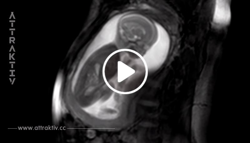 Magnet-Radiografie zeigt die Bewegungen des Ungeborenen – schau dir den Clip an, der Millionen fasziniert!