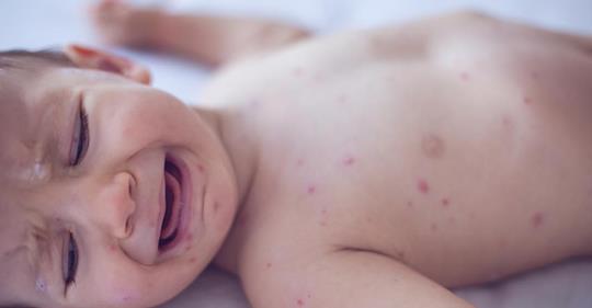  Nachdem ein 11 Monate altes Baby einen Schlaganfall erleidet, empfehlen Ärzte Eltern nicht die Impfungen ihrer Kinder zu vernachlässigen