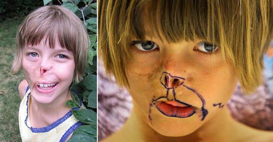 Gesicht von Mädchen wurde von Waschbär angegriffen, 13 Jahre später erfüllt sich Traum