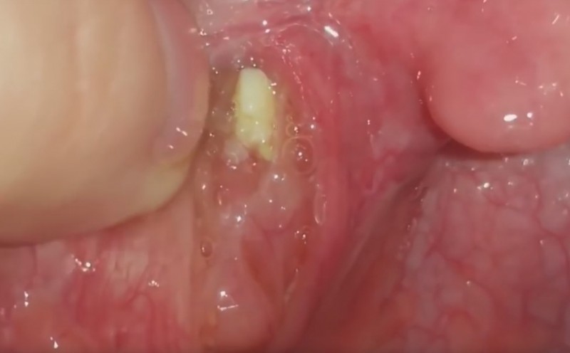 Tonsilliensteine können für Mundgeruch sorgen.