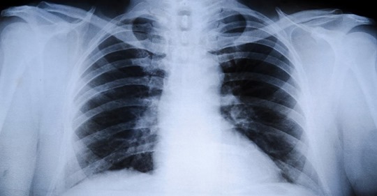 Kita in Abbenrode: Mitarbeiter und Kind mit Tuberkulose infiziert