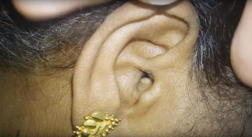Dieses Video bereitet Albträume: Die Ursache der Kopfschmerzen dieser Frau war eine Spinne in ihrem Ohr