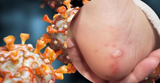 Frostbeulen und Juckreiz: Dermatologen zeigen, wie sich Covid-19 in die Haut frisst