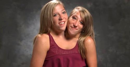 Abby und Brittany Hensel: Die siamesischen Zwillinge, die weltweit berühmt wurden