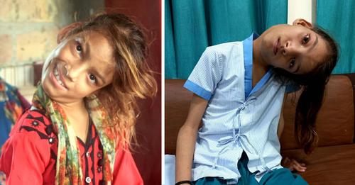 Hals dieses Mädchen steckt jahrelang in einem 90 Grad Winkel fest – Operation verändert ihr Leben